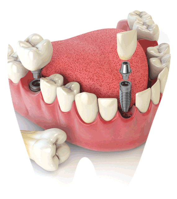 Dental Implant in dahisar